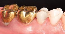 Crowns and Bridges - Life™ Premium Highly Translucent Zirconia Restorations